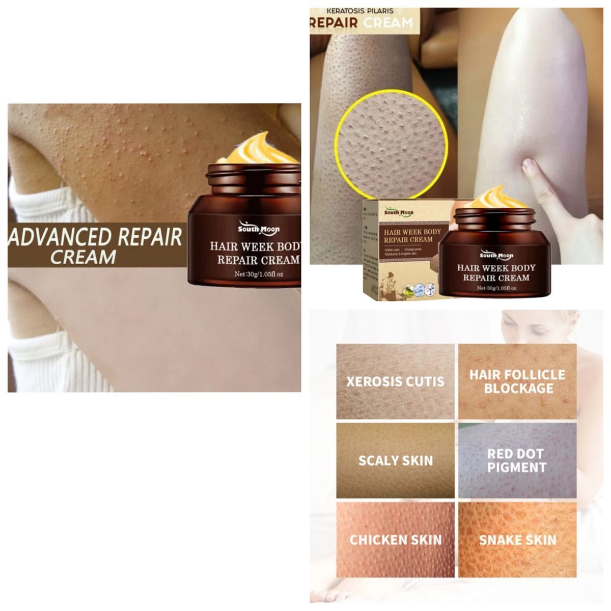 Keratosis Pilaris Repair Cream, Chicken Skin Goose Bump Removal Cream