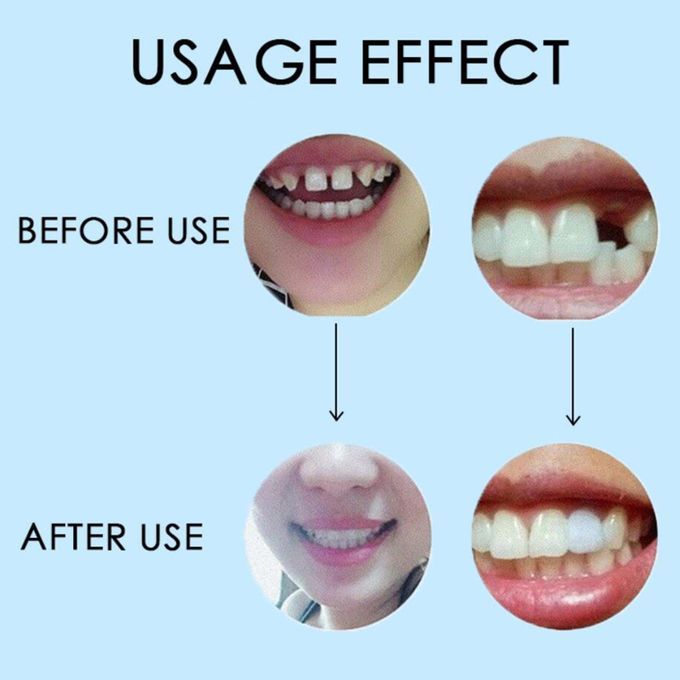 Dental Thermal Beads 150g Moldable Denture Temporary Teeth 25g 1