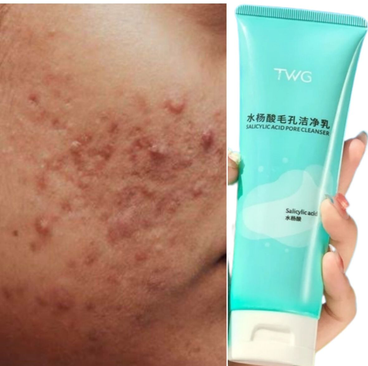 Salicylic Acid Pore  Cleanser