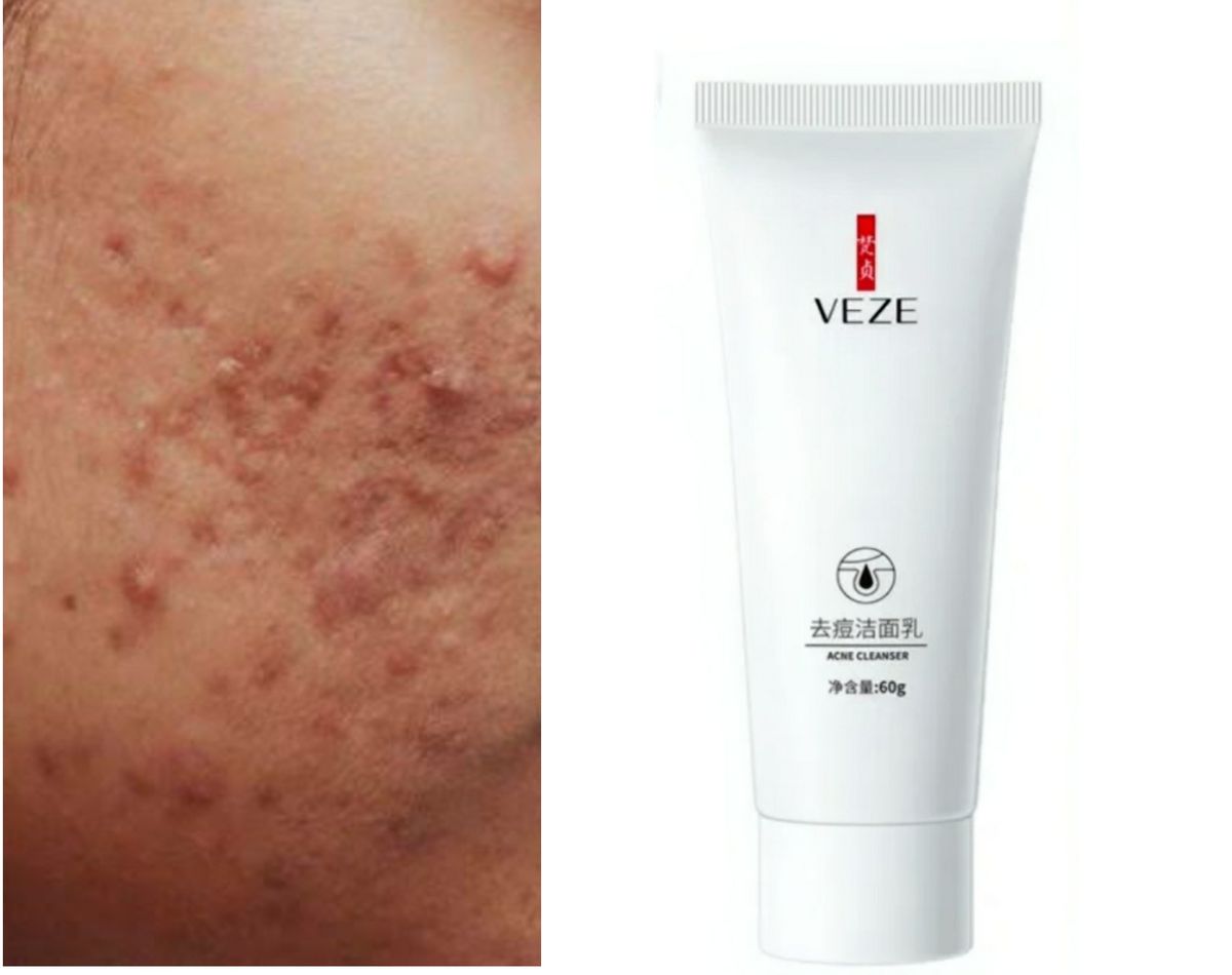 Acne Facial Wash/ Cleanser ( Clear Acne &  Oil Control For Acne Prone Skin).