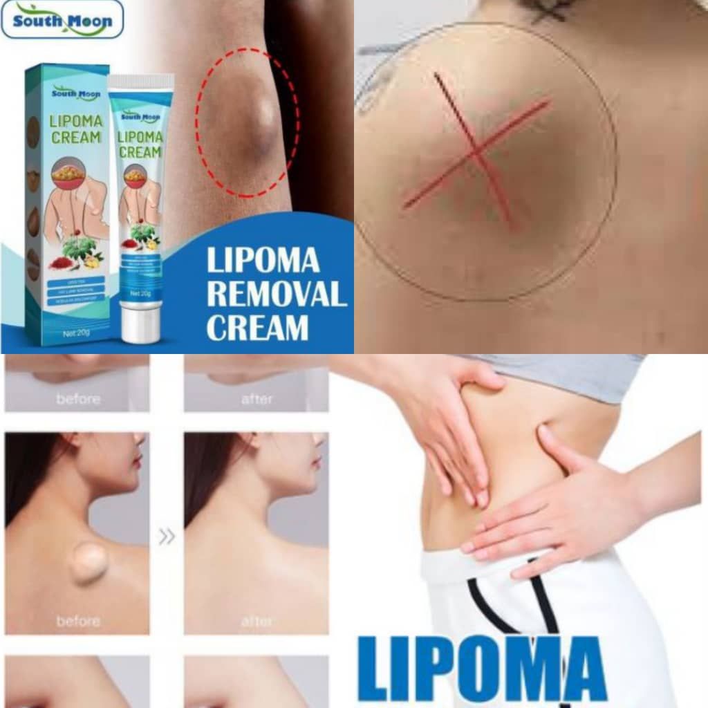 Effective Lipoma Removal Cream / Herbal Ointment For Skin Lump, Benign Lipoma And Tumor
