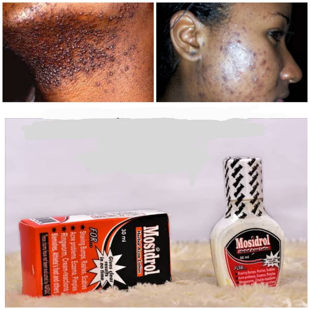 Mosidrol For Pimples, Razor Shave Bumps