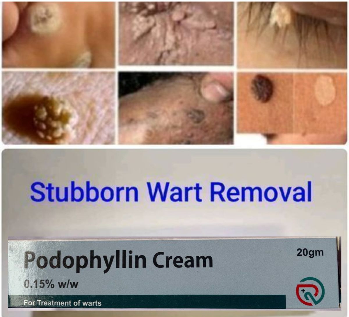 Podophyllin Wart Cream